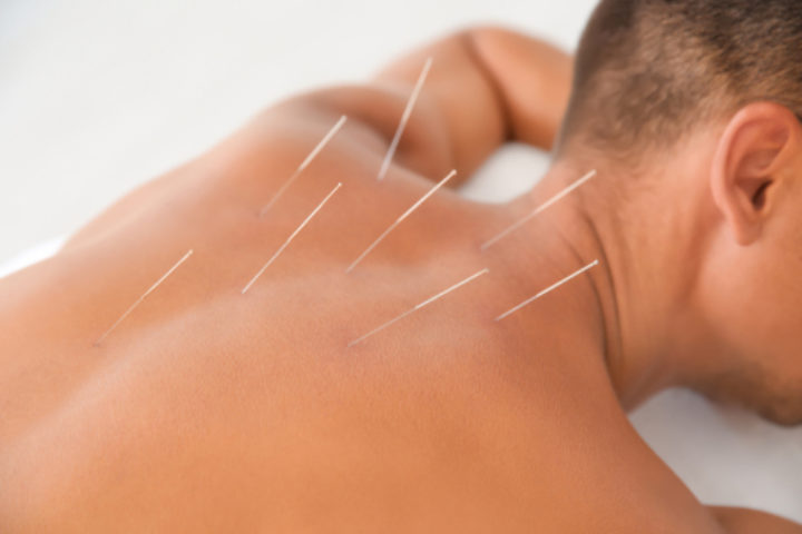 Skuldersmerter og akupunktur